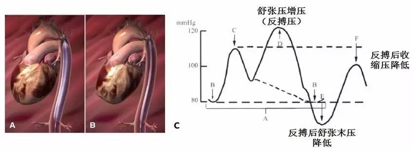 主动脉内球囊反搏的临床应用现状和进展