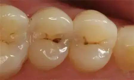 很多蛀牙有洞怎么处理,多颗蛀牙为什么要分别去弄