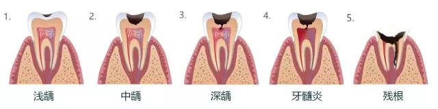 多颗门牙蛀牙烂洞怎么修复,10岁男孩多颗蛀牙怎么办