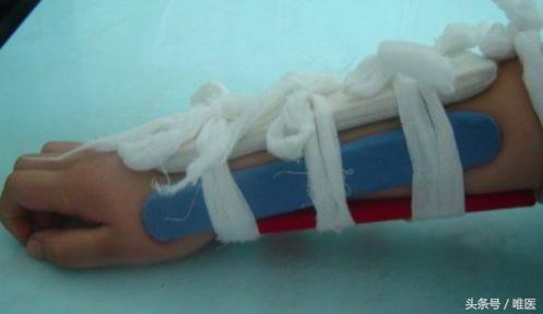 小孩尺桡骨骨折后期自我塑形,儿童尺骨桡骨远端骨折第九周