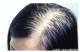 女性头发稀疏原因,女性头顶头发稀少怎么生发