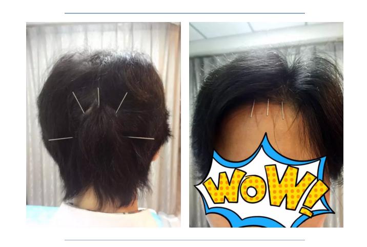 头痛太阳针灸一针见效,针灸对眩晕症有效果吗