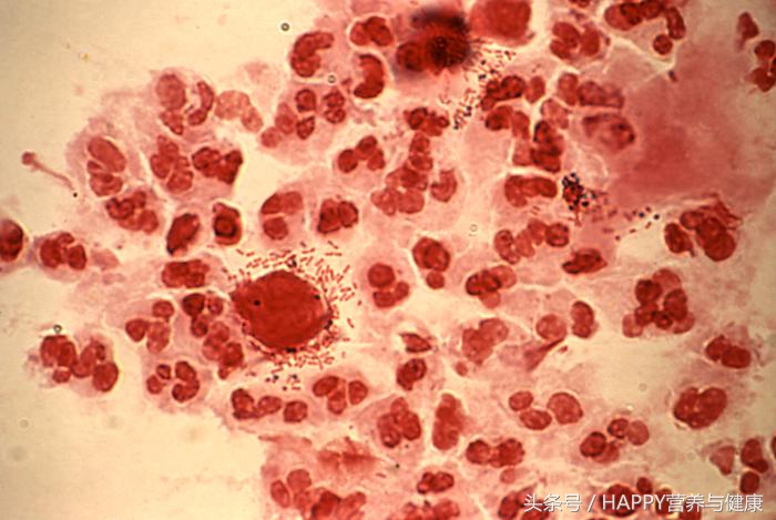 女人白带的6种状态，隐藏着重要的疾病信号，一定要小心！