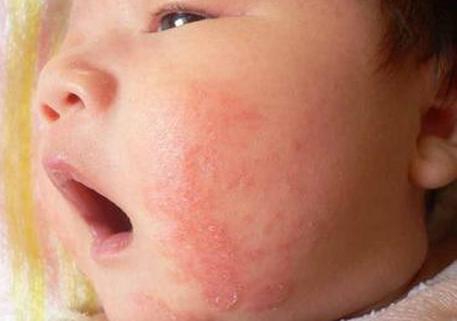 孩子食物过敏需要吃药吗,孩子食物过敏要不要去幼儿园