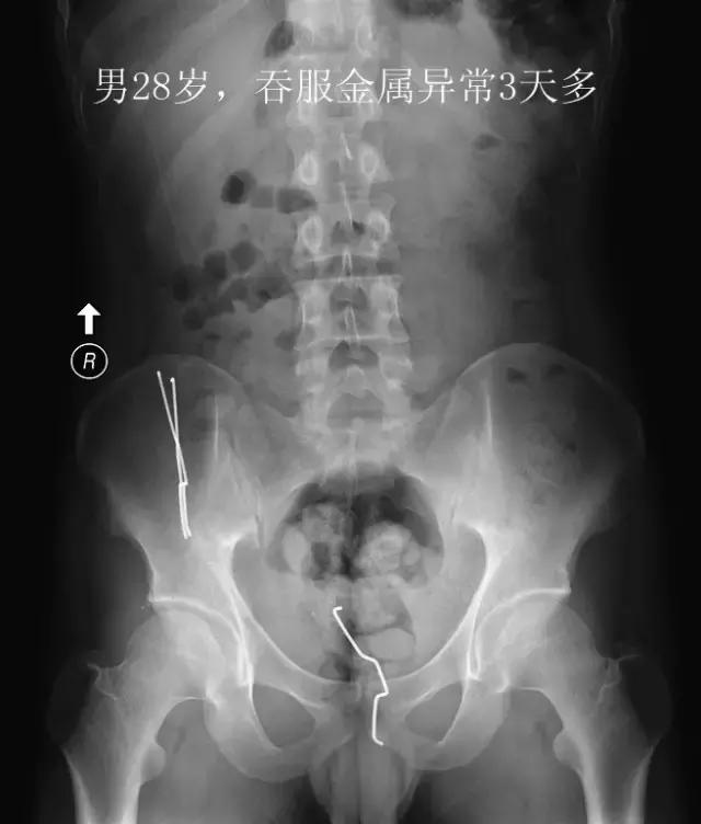 X光片里的体内异物，简直大开眼界