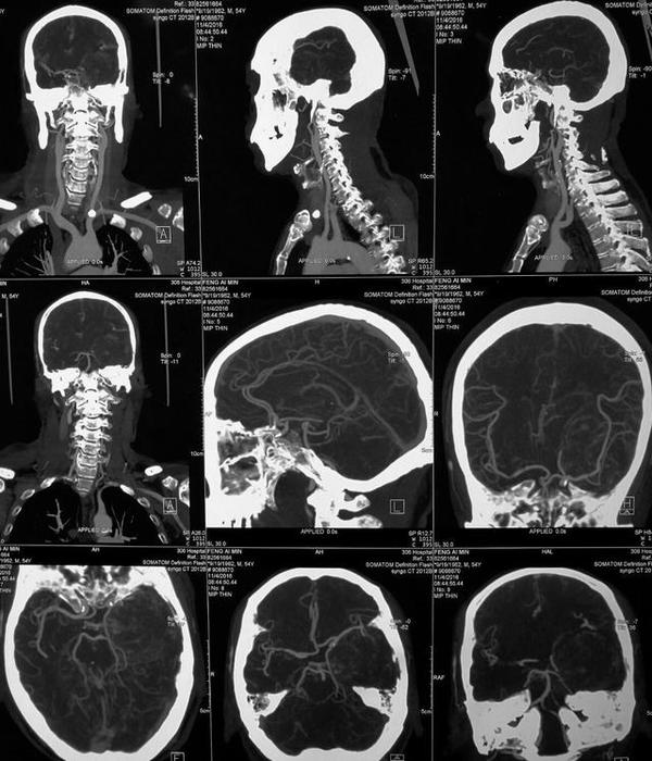 海绵窦海绵状血管瘤,海绵窦区海绵状血管瘤发病年龄