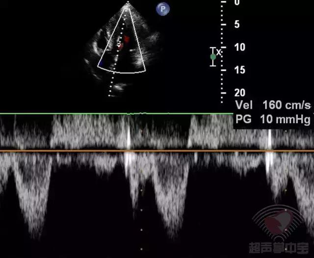 超声肥厚心肌病视频教学,梗阻性肥厚型心肌病消融术