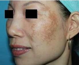 皮秒激光祛斑的副作用,激光c6祛斑副作用