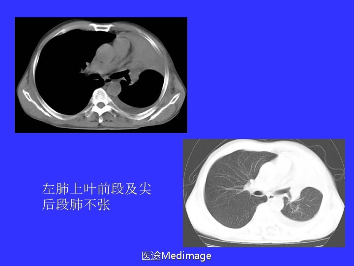胸部ct扫描双肺未见明显异常,胸部ct报告心脏不大正常吗