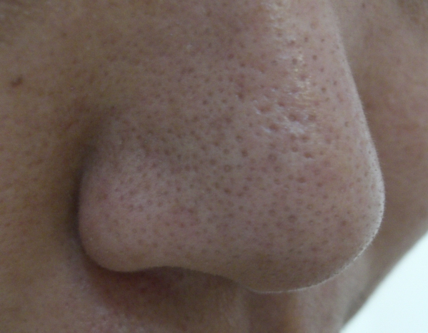 毛孔粗大收缩毛孔最有效的土方法,毛孔粗大怎么办教你快速收缩毛孔