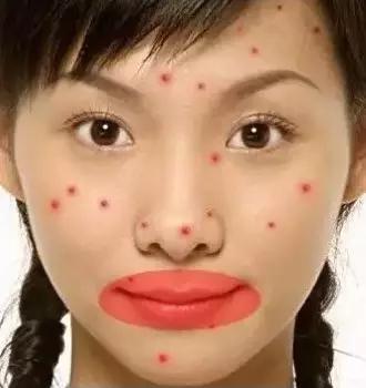 突然长很多痘是有什么病吗,3种长痘的原因了解一下你中了吗