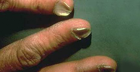 观手知健康指甲有白点怎么回事,当指甲发绿发脓的时候要怎么处理