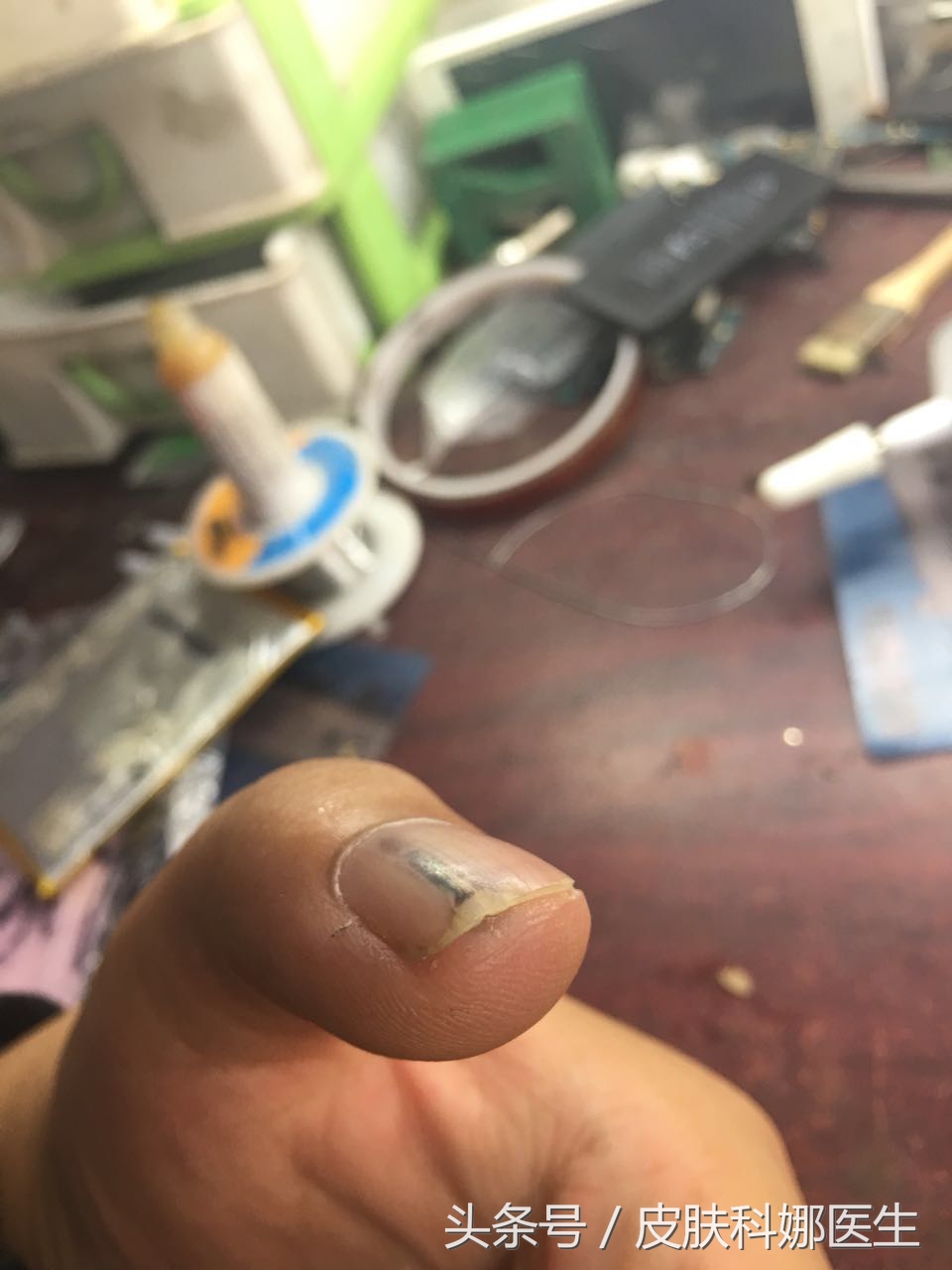 指甲上出现了一条裂缝,指甲上有竖条纹开裂是怎么回事