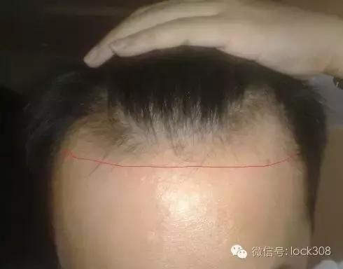 头顶稀疏发缝宽脂溢性脱发怎么办,前额头顶脱发稀疏细软怎样办