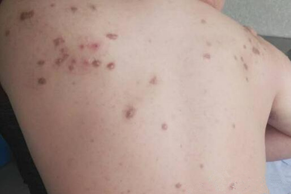 前方高能!吸食*毒冰**后皮肤症状(图文)