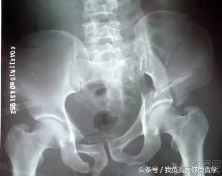 正常骨盆x线片详解,骨科医生只看报告单