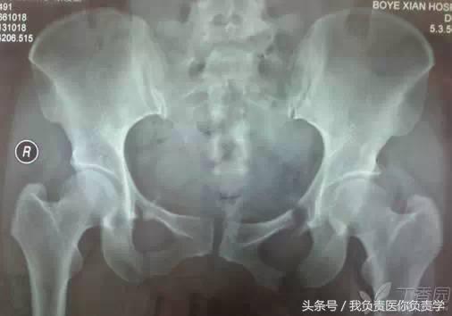 正常骨盆x线片详解,骨科医生只看报告单