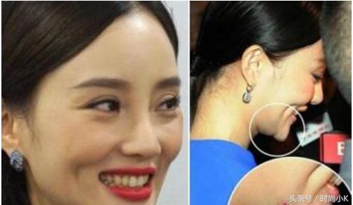 沈梦辰下巴真实照片,沈梦辰取鼻假体