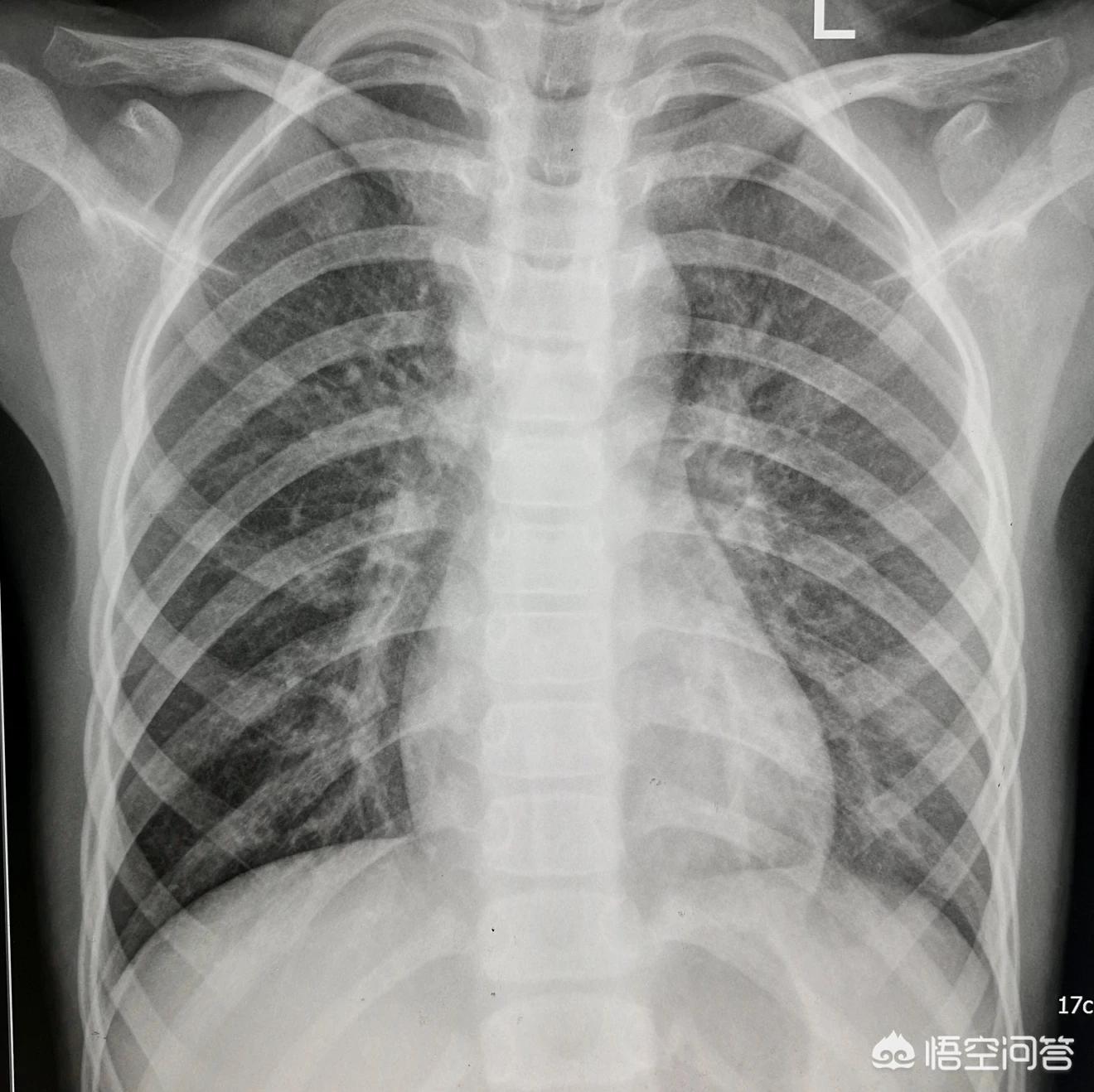 小孩得了肺炎需要打疫苗吗,小孩得了肺炎要打疫苗吗