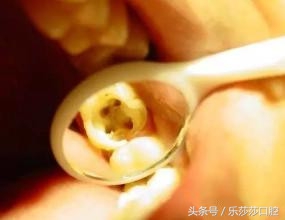 杀神经后牙齿还疼,杀牙神经的牙齿遇热会疼