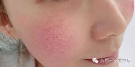 一到冬天脸就发红发烫解决方法,一到冬天脸很热发红起皮怎么回事