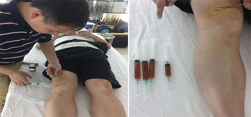 痛风性关节炎的手腕积液需要抽吗,痛风膝关节积液反复疼痛