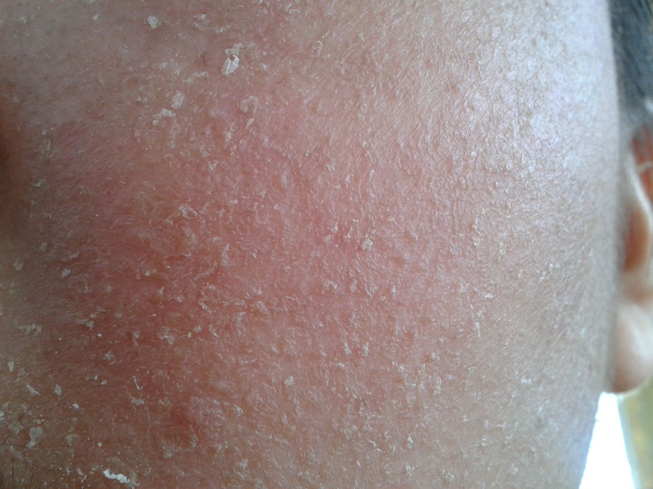 激素皮炎喝中药能彻底治愈吗,激素依赖性皮炎用中药更严重