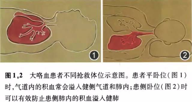 支气管镜诊疗操作大出血,做支气管镜大出血怎么回事