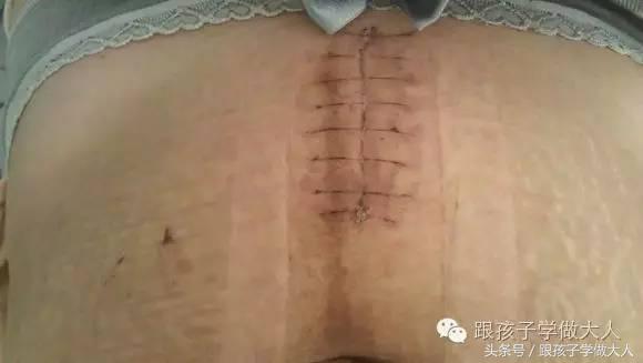 剖腹产8大禁忌,剖腹产后注意事项及禁忌
