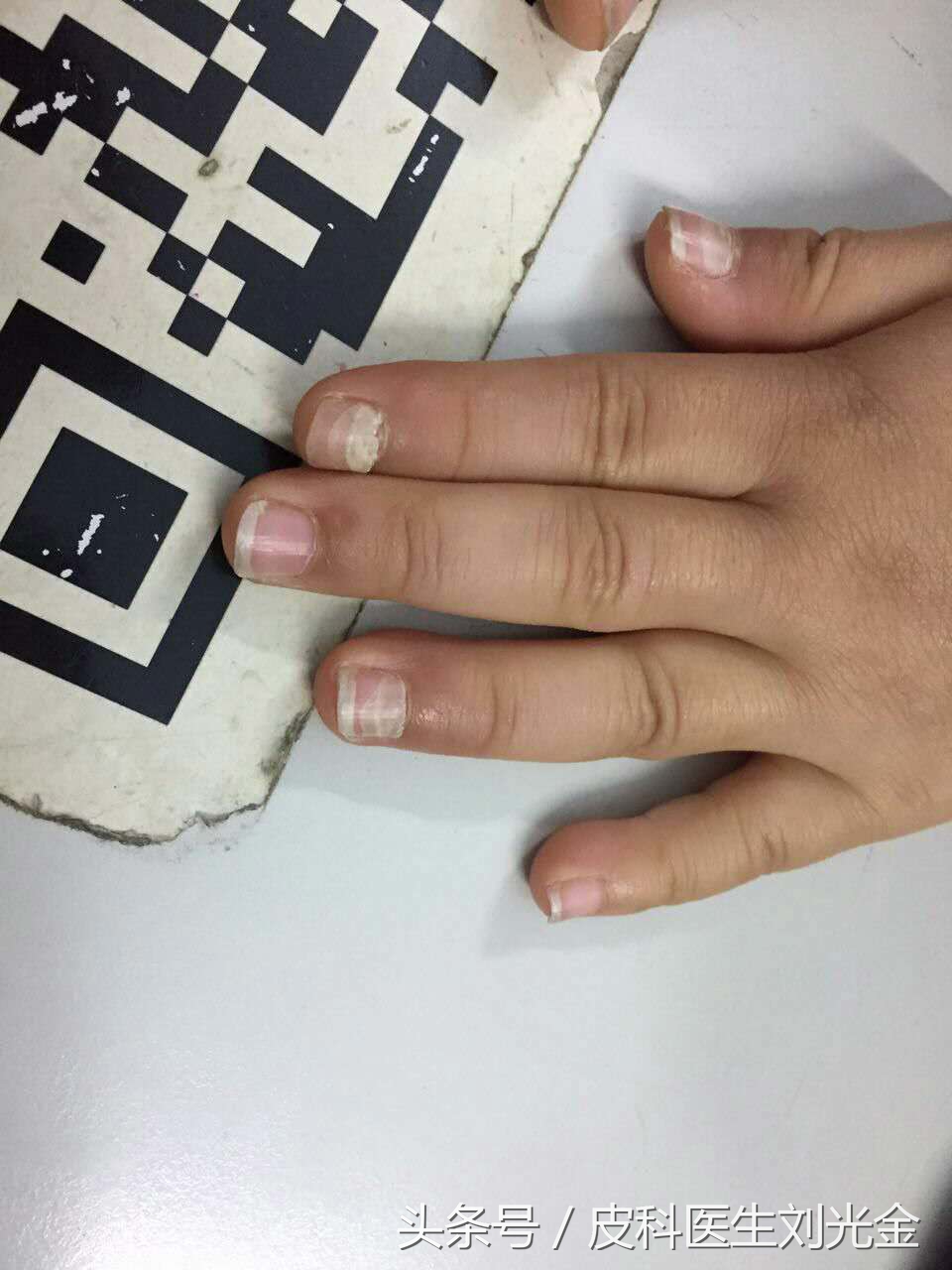 宝宝指甲脱落怎么回事,30个月宝宝指甲脱落是怎么回事