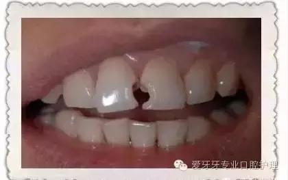 烤瓷牙和全瓷牙的区别和价格,贵的烤瓷牙和便宜的有区别吗