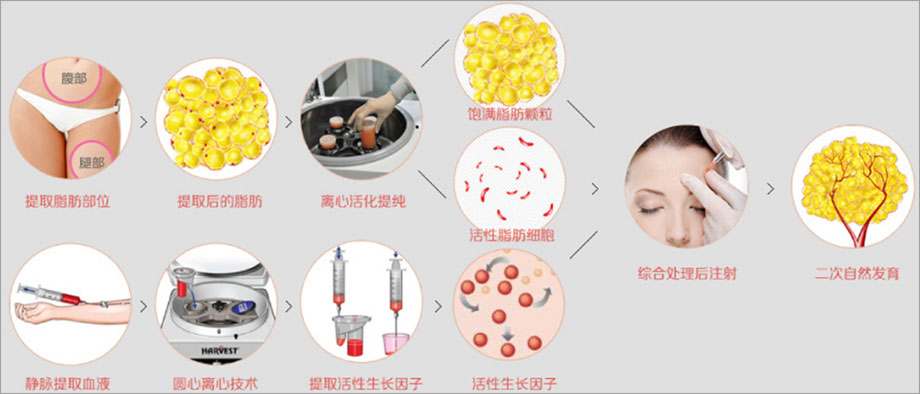 自体脂肪填充额头太高怎么消下去,额头自体脂肪填充额头太过饱满