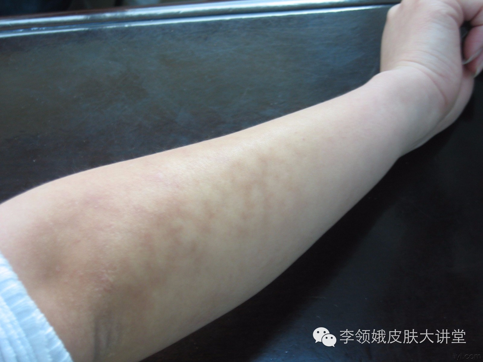 火激性红斑跟烤什么有关,火激红斑为什么会把皮肤烤脱色