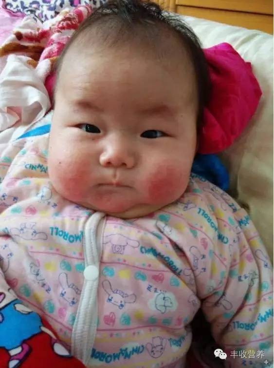 治疗宝宝湿疹家长请收好调理食谱,宝宝湿疹怎么给宝妈解释