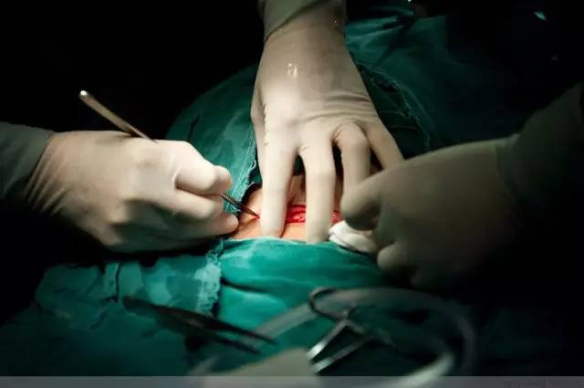 剖腹产恢复很好的照片,剖腹产完全恢复照片