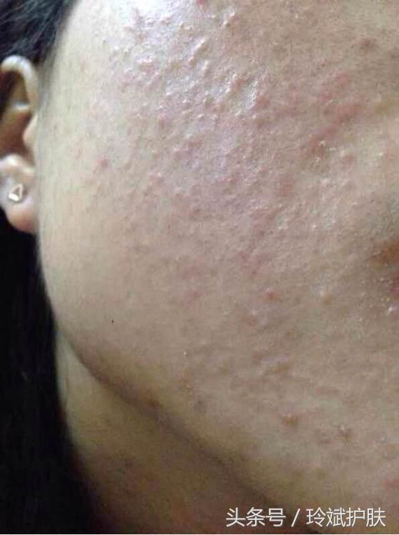 闭合性粉刺怎么去除阿达帕林,闭合性粉刺怎么去除额头