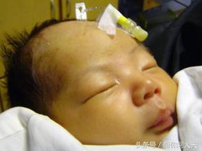 病理性黄疸有没有生命危险,得过黄疸的小孩后期皮肤会发黄吗