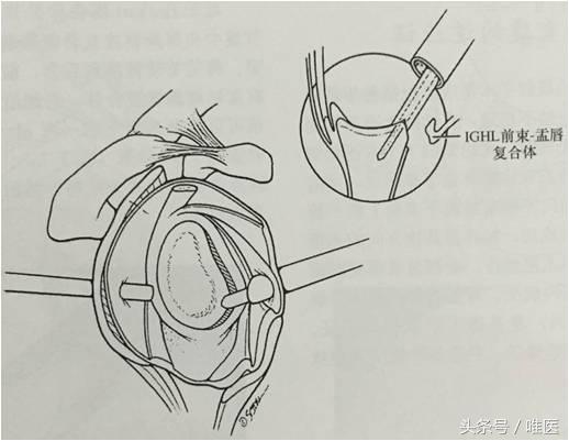 肩关节镜修复方法,肩关节镜下半骨道修复技术