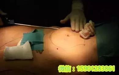 真实有效的减肥方式,放血疗法可以减肥吗