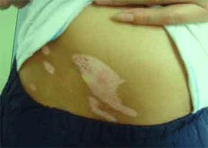 308治疗白癜风需要多久？效果很好吗？