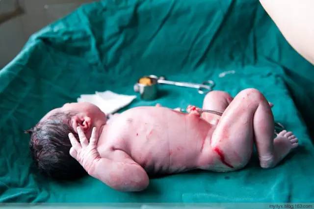 剖腹产恢复很好的照片,剖腹产完全恢复照片