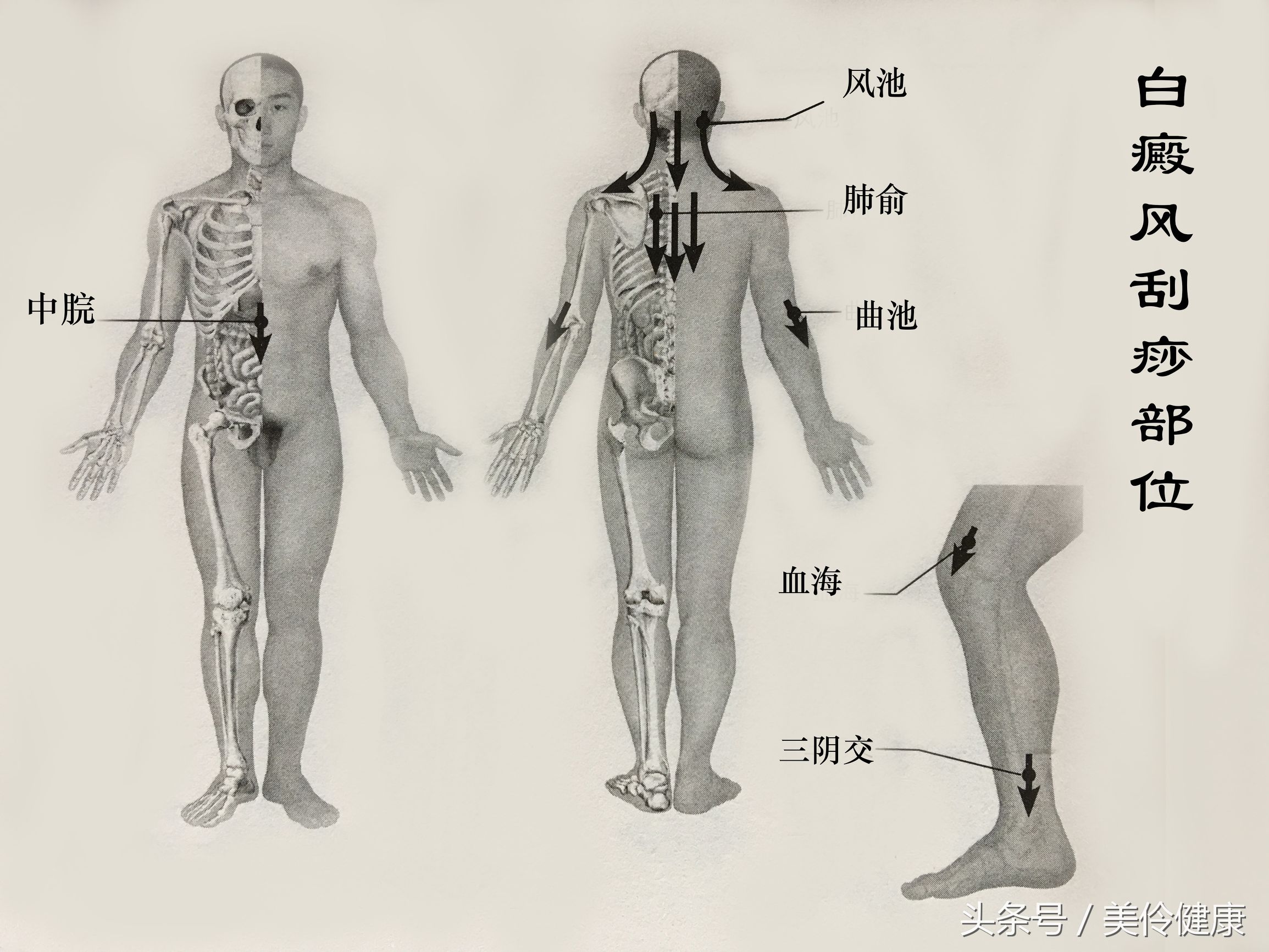 刮痧治疗白癜风偏方,荨麻疹刮痧疗法
