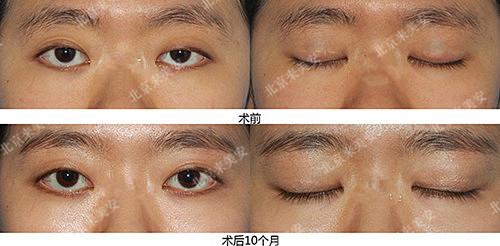 双眼皮手术眼角不对称,左右双眼皮不对称怎么改善
