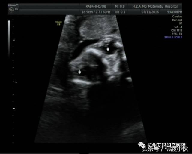 “借我,借我一双慧眼吧”——胎儿眼畸形
