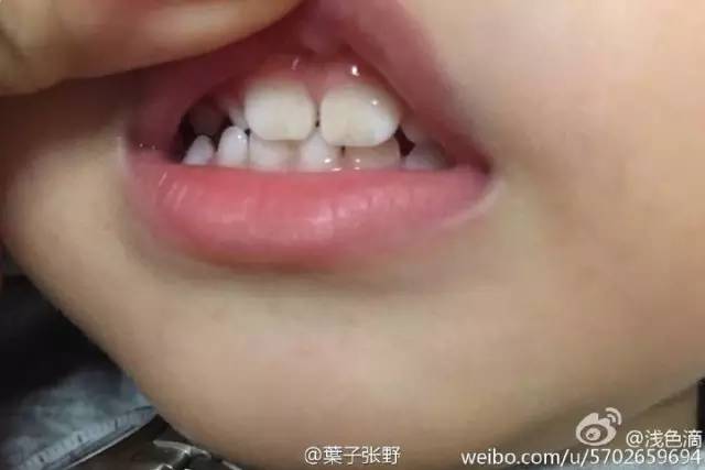 小孩牙齿不齐换牙后会变好吗,为什么换牙后牙齿不齐