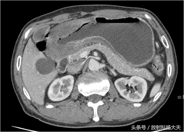 胃癌晚期出现肝转移中药保守治疗,无任何症状突然重度贫血