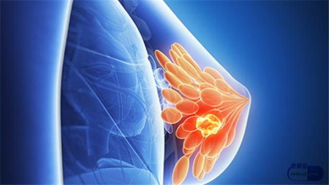 乳腺癌术后一年一般能活多久,乳腺癌手术后复发了还能活多久