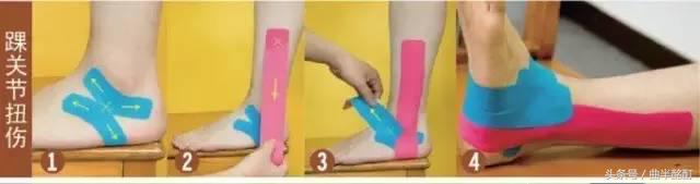 科普足踝扭伤防治,踝关节扭伤处理视频