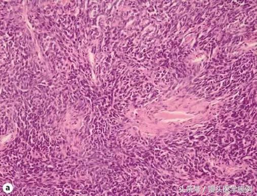 卵巢肿瘤穿刺活检结果,卵巢囊肿穿刺从哪穿刺