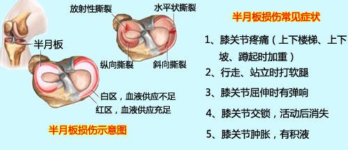 半月板科普儿童,半月板健康知识